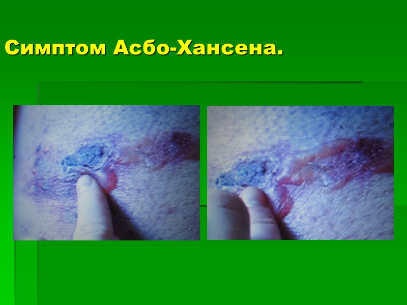 Симптом Асбо-Хансена.